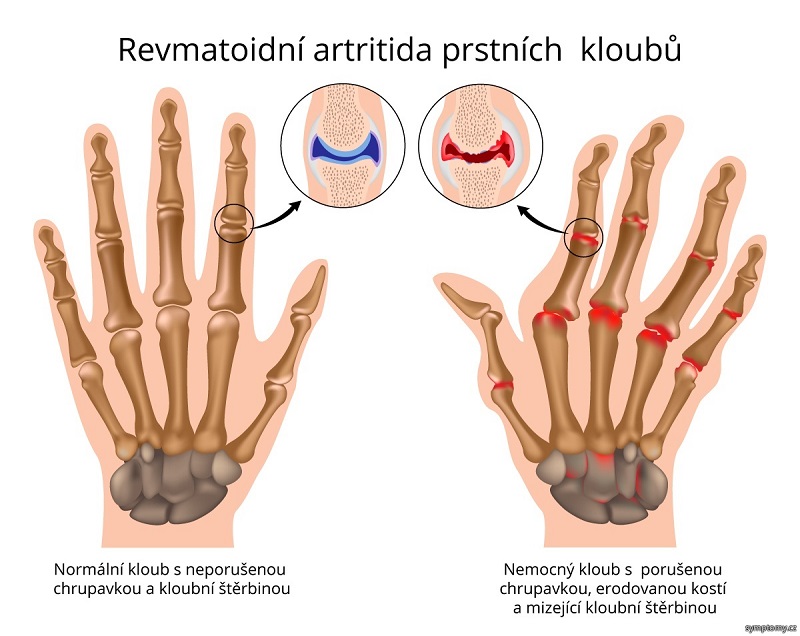 Jak zastavit revma?