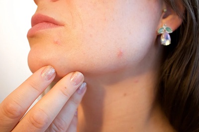 Aknózní pleť | Dentimedshop.cz Aknózní pleť