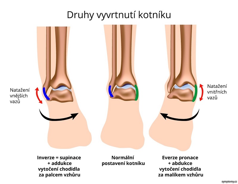 artroza kotníku otok inflamația articulațiilor degetului mic al piciorului