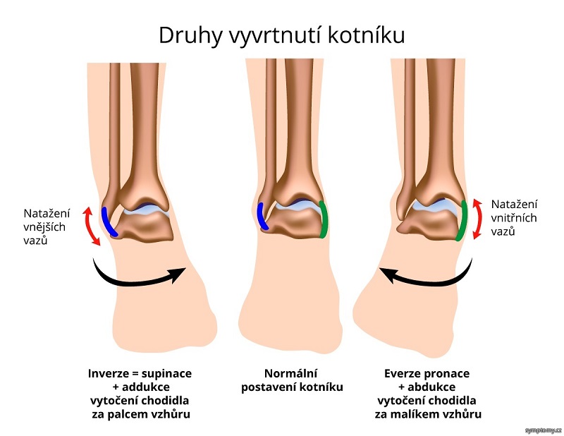 Jak vypadá vymknutý kotník?