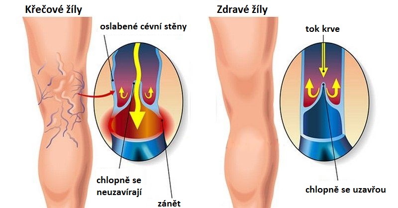 Křečové žíly