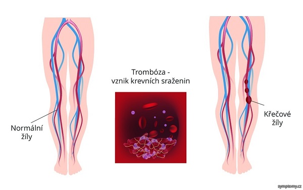 tromboza