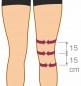 Ortex 04B Ortéza kolenní s přestavitelným rozsahem pohybu krátká